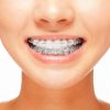 braces