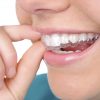invisalign